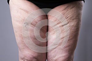 Varicose veins closeup. Thick female legs