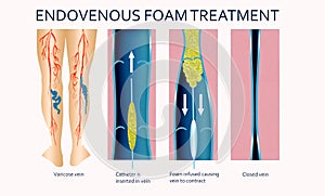 Varicose Veins. Endovenous foam Treatment. Structure of vein photo