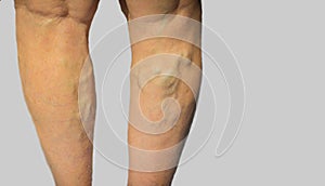 Varicose veins on a female legs