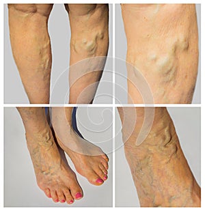 Varicose veins on a female legs