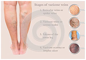 Varicose veins on a female senior leg