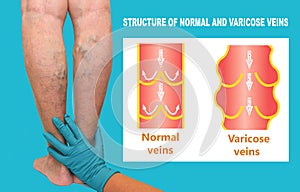 Varicose veins on a female senior legs. The structure of normal and varicose veins