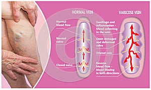 Varicose veins on a female senior legs. The structure of normal and varicose veins.