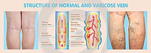 Varicose veins on a female senior legs. The structure of normal and varicose veins.