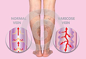 Varicose veins on a female senior legs. The structure of normal and varicose veins.