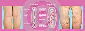 Varicose veins on a female senior legs. The structure of normal and varicose veins.