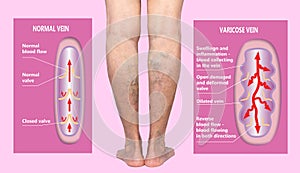 Varicose veins on a female senior legs. The structure of normal and varicose veins.