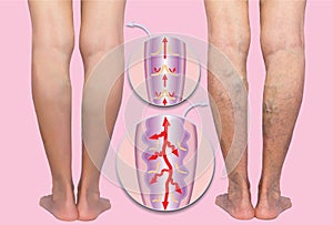 Varicose veins on a female senior legs. The structure of normal and varicose veins.