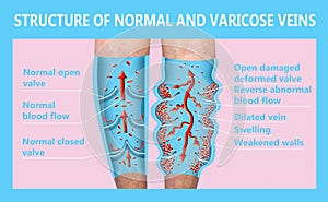 Varicose veins on a female senior legs. The structure of normal and varicose veins.