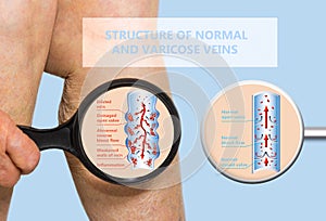 Varicose veins on a female senior legs. The structure of normal and varicose veins.