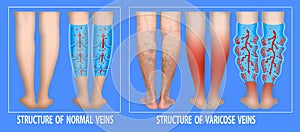 Varicose veins on a female senior legs. The structure of normal and varicose veins.