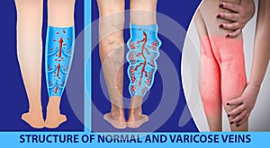 Varicose veins on a female senior legs. The structure of normal and varicose veins.