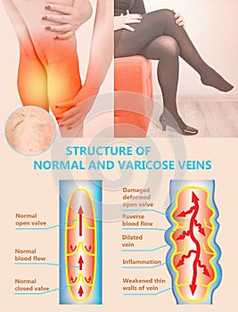 Varicose veins on a female senior legs. The structure of normal and varicose veins.