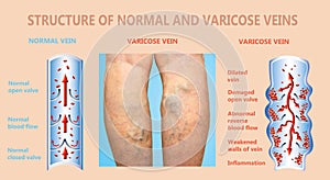 Varicose veins on a female senior legs. The structure of normal and varicose veins. photo