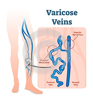 Varicose veins with irregular blood flow and healthy veins vector illustration diagram scheme.