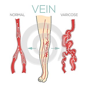 Varicose veins, large, swollen vein on the legs and feet. Medical schematic