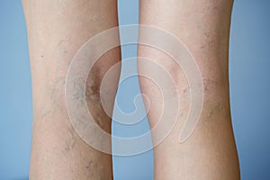 Varicose veins photo