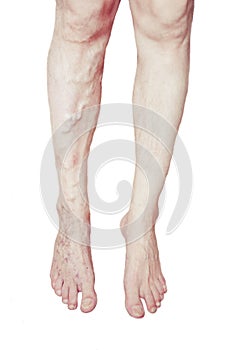 Varicose Veins on the leg