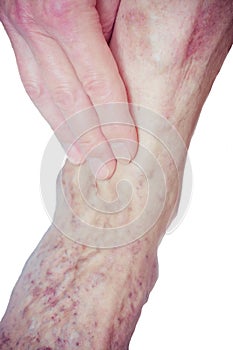 Varicose Veins on the leg