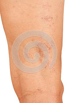 Varicose veins on the legs