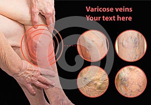 The varicose veins on a legs of old woman on gray