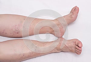 Varicose veins in the legs of a woman, white background, varicose veins on the calves of the legs and lower legs, phlebeurysm