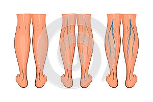 Varicose veins of the lower extremities