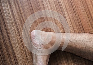 Varicose veins on man leg or foot,Body and health care concept,Selective focus