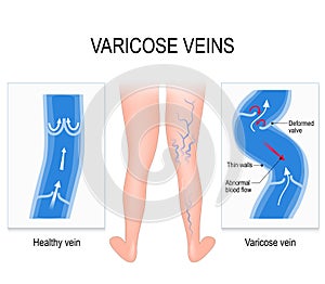 Varicose veins. Medical illustration