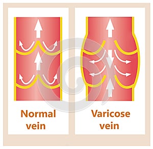 The varicose veins and normal veins