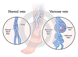 Varicose veins poster photo