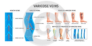 Varicose Veins Realistic Infographics