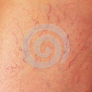 Varicose veins on the thigh of a woman close up.