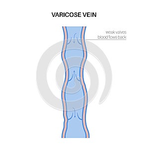 Varicose veins treatment