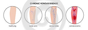 Varicose veins treatment