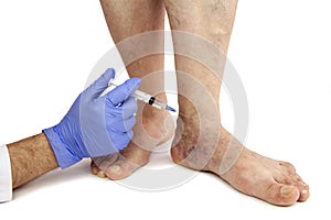 Varicose veins treatment