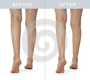 Before and after varicose veins treatment. Collage with photos of woman showing legs on white background, closeup