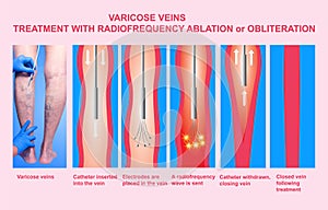 Varicose Veins and Treatment with radiofrequency ablation photo