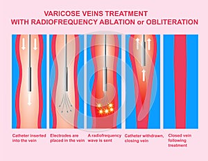 Varicose Veins and Treatment with radiofrequency ablation