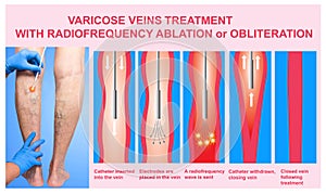 Varicose Veins and Treatment with radiofrequency ablation photo