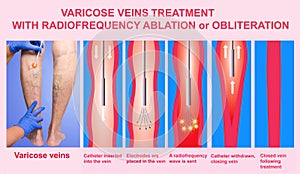 Varicose Veins and Treatment with radiofrequency ablation photo