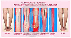 Varicose Veins and Treatment with radiofrequency ablation photo