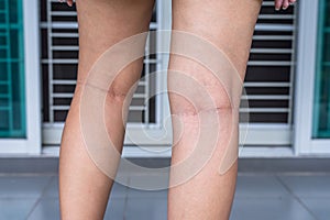 Varicose veins on the woman leg or foot,Body and health care concept,Selective focus