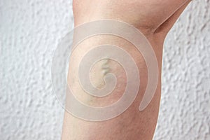 Varicose veins on a woman leg, a node under the knee