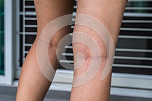 Varicose veins on the woman leg, Normal veins near the skin layer swell out, And blood is accumulated to see a bloody blue or dark