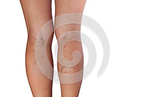 Varicose veins of woman legs