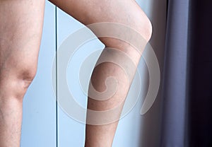 Varicose veins on the womans leg or foot,Body and health care concept