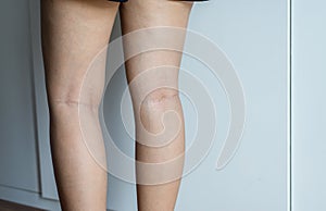 Varicose veins on the womans leg,Normal veins near the skin layer swell out,And blood is accumulated to see a bloody blue or dark