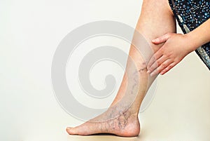 Varicose veins on the womans legs