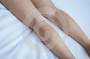 Varicose veins on the womans legs,Close up,Concept for health